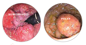 Hemorrhoid and Polys in colon 